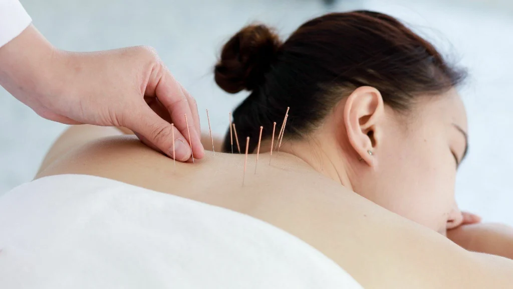 Acupuncture